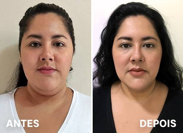 Mágicofacial pro - Dispositivo de lifting Facial V