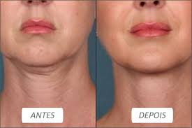 Mágicofacial pro - Dispositivo de lifting Facial V